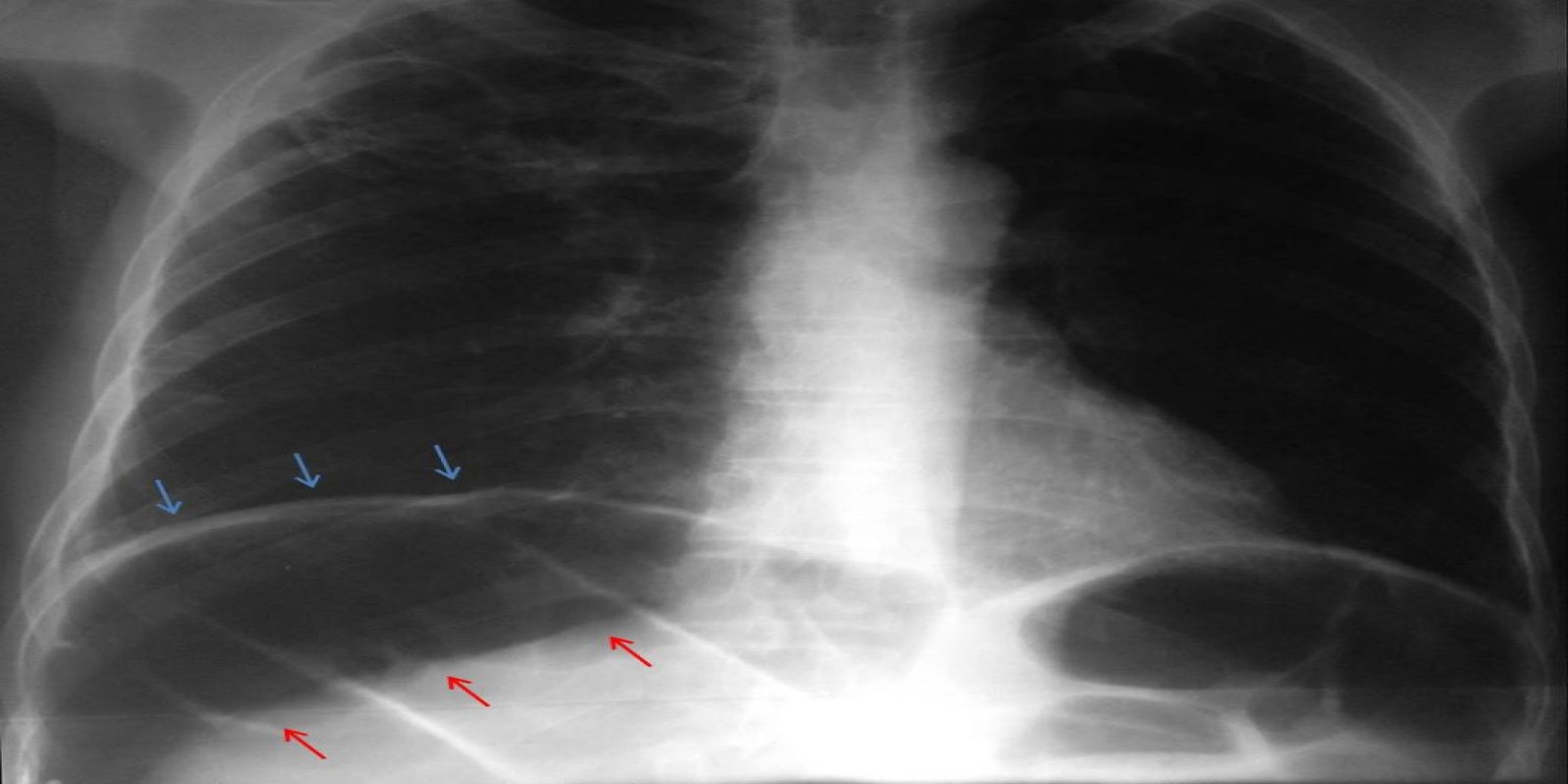 Can breast cancer be resulting from asbestos lymphohistiocytic malignant mesothelioma