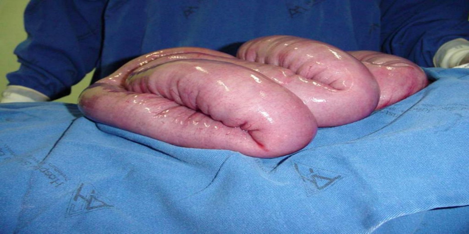 Caso Código 001B de Obstrução Intestinal do Delgado 001B