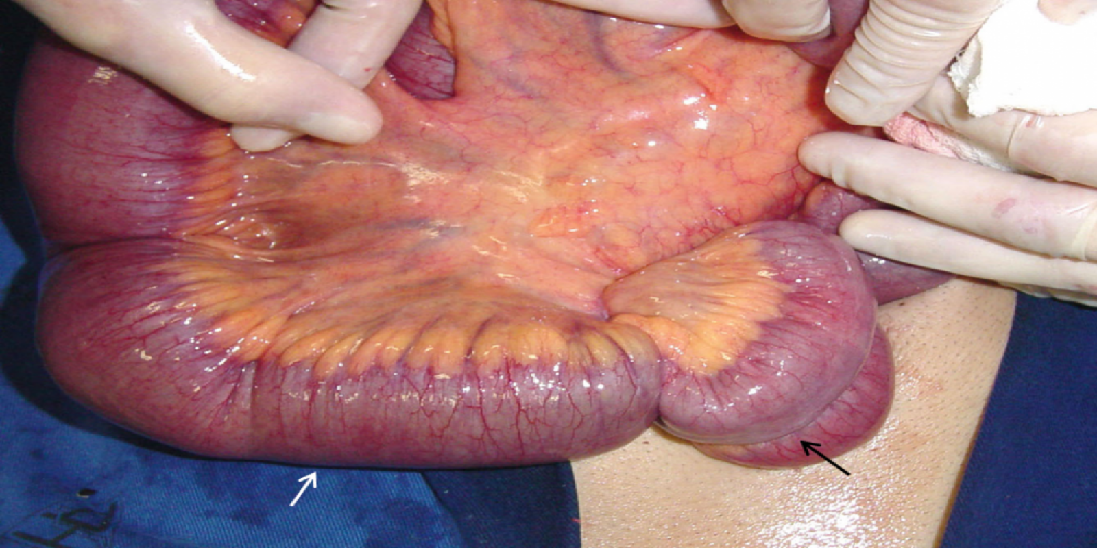 Caso Código 001C de Obstrução Intestinal do Delgado 001C