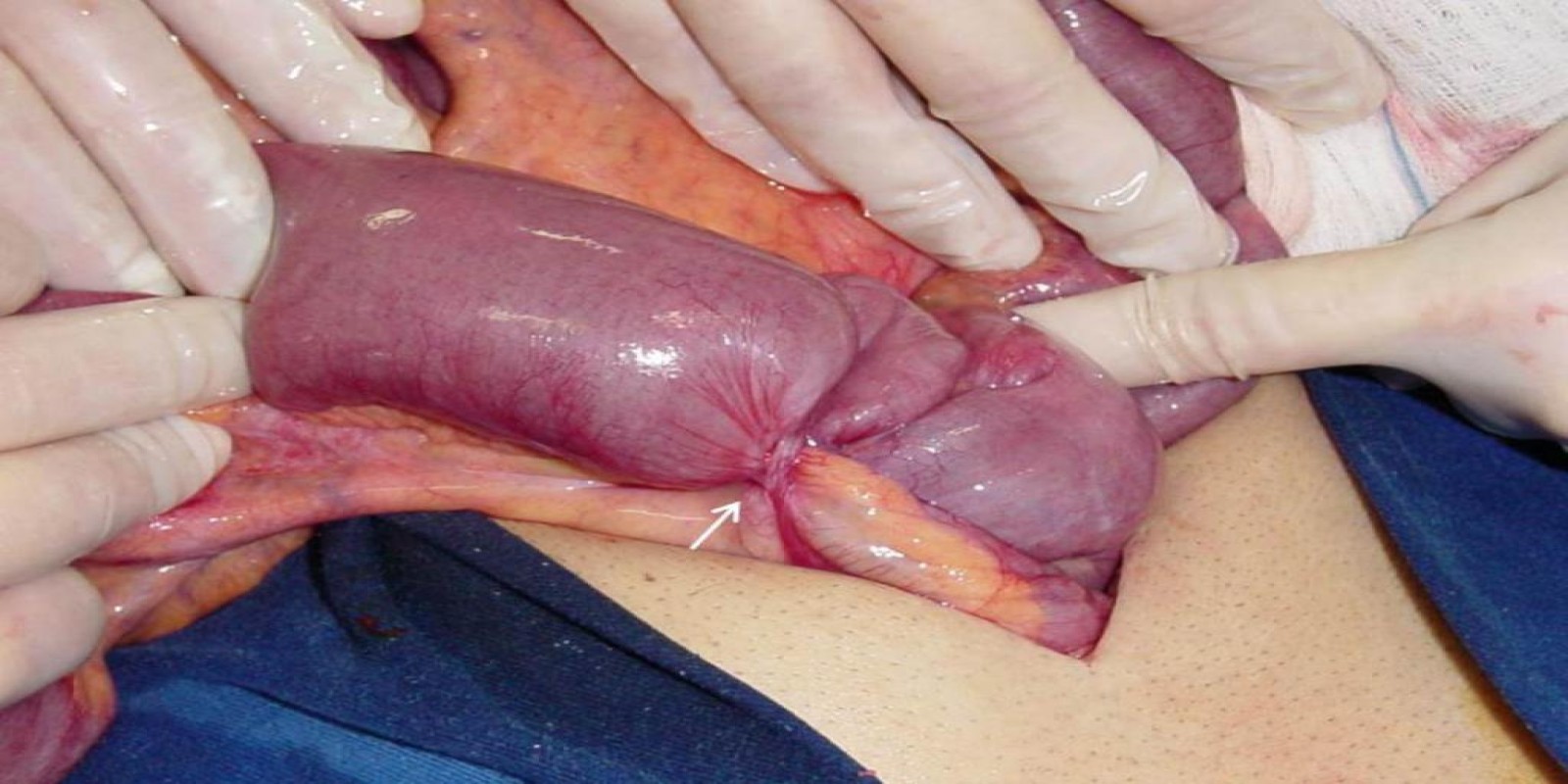 Caso Código 001D de Obstrução Intestinal do Delgado 001D