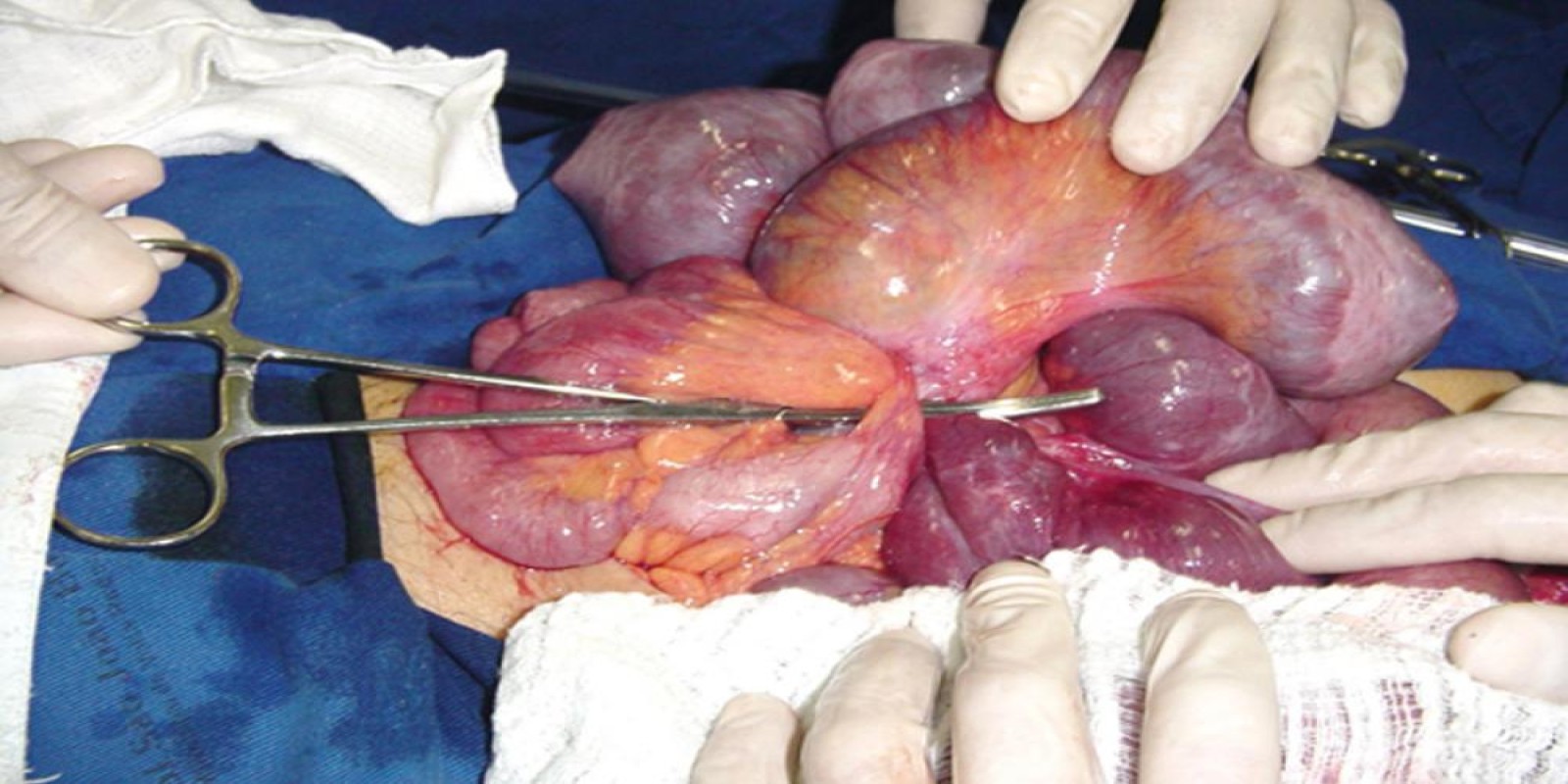 Caso Código 002E de Obstrução Intestinal do Delgado 002E