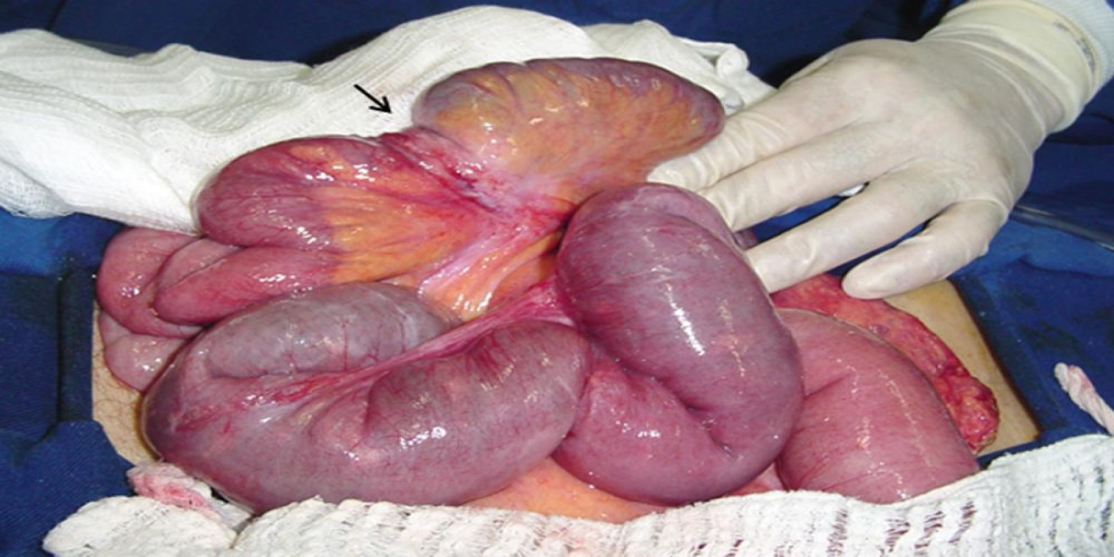 Caso Código 002F de Obstrução Intestinal do Delgado 002F