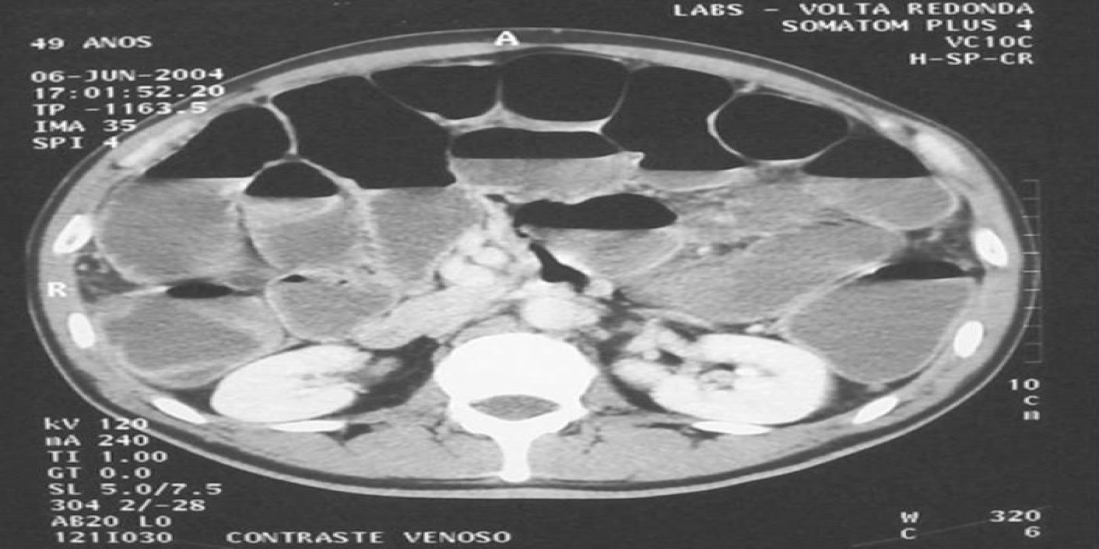 Caso Código 010A de Obstrução Intestinal do Cólon 010A