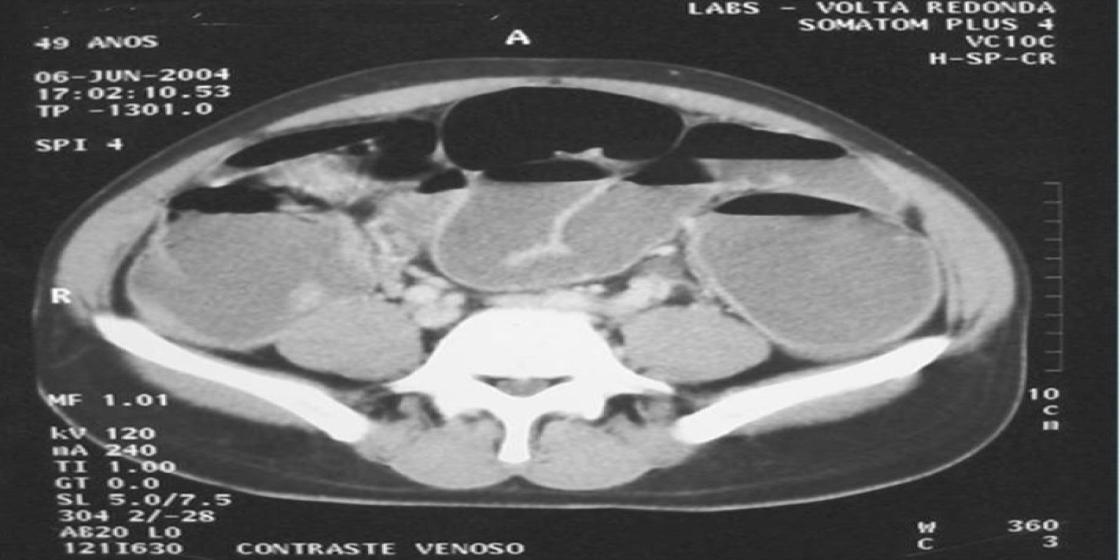 Caso Código 010B de Obstrução Intestinal do Cólon 010B