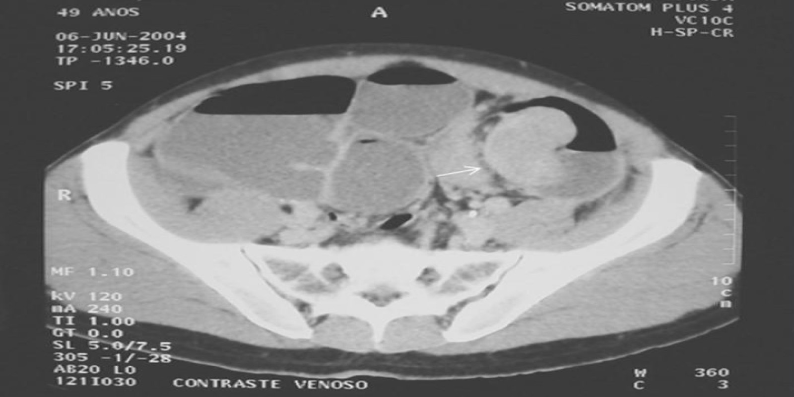 Caso Código 010C de Obstrução Intestinal do Cólon 010C