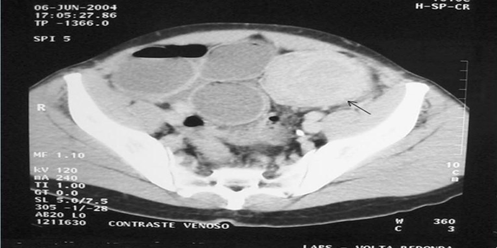 Caso Código 010D de Obstrução Intestinal do Cólon 010D