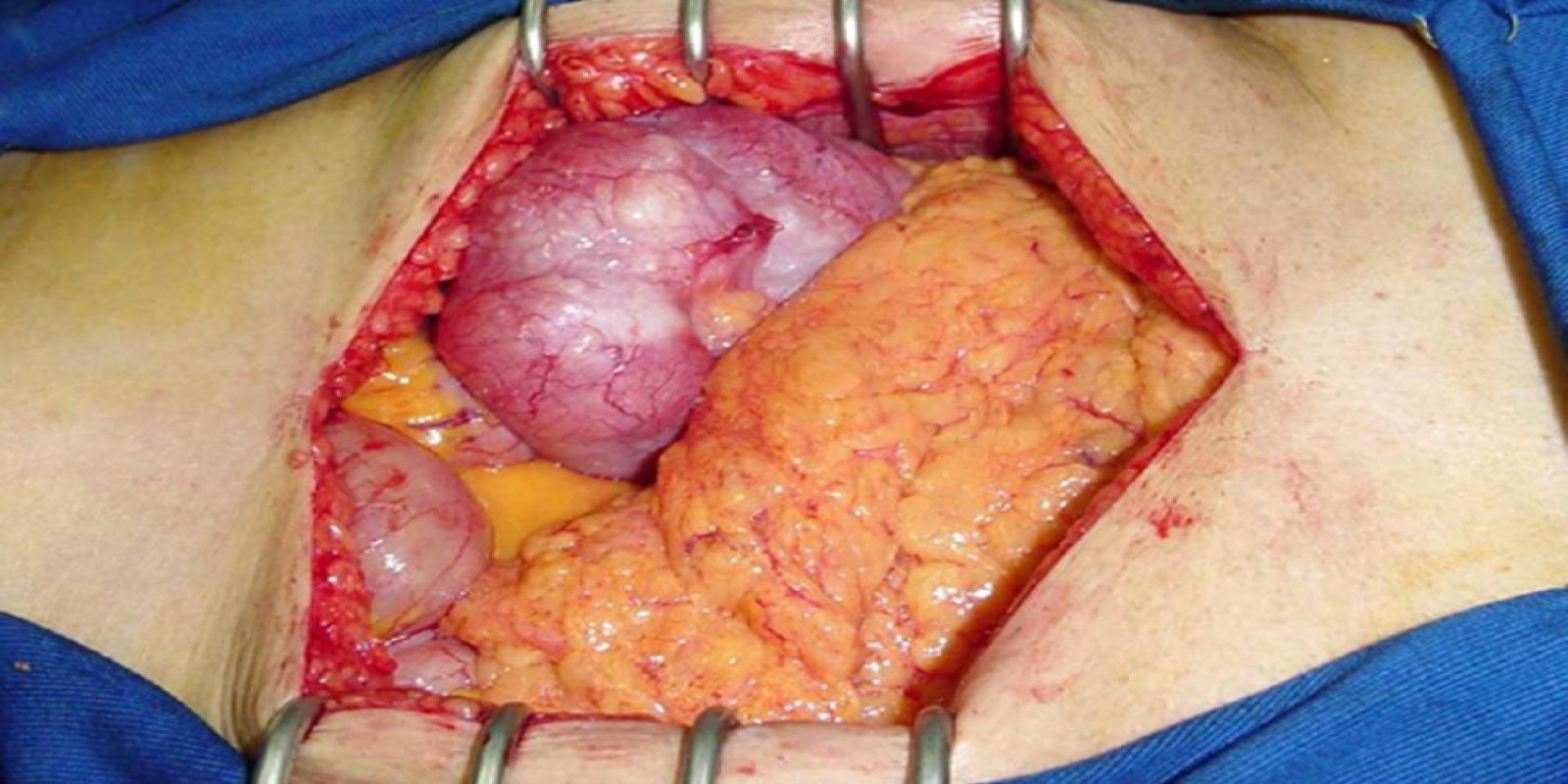 Caso Código 011B de Câncer do Cólon 011B