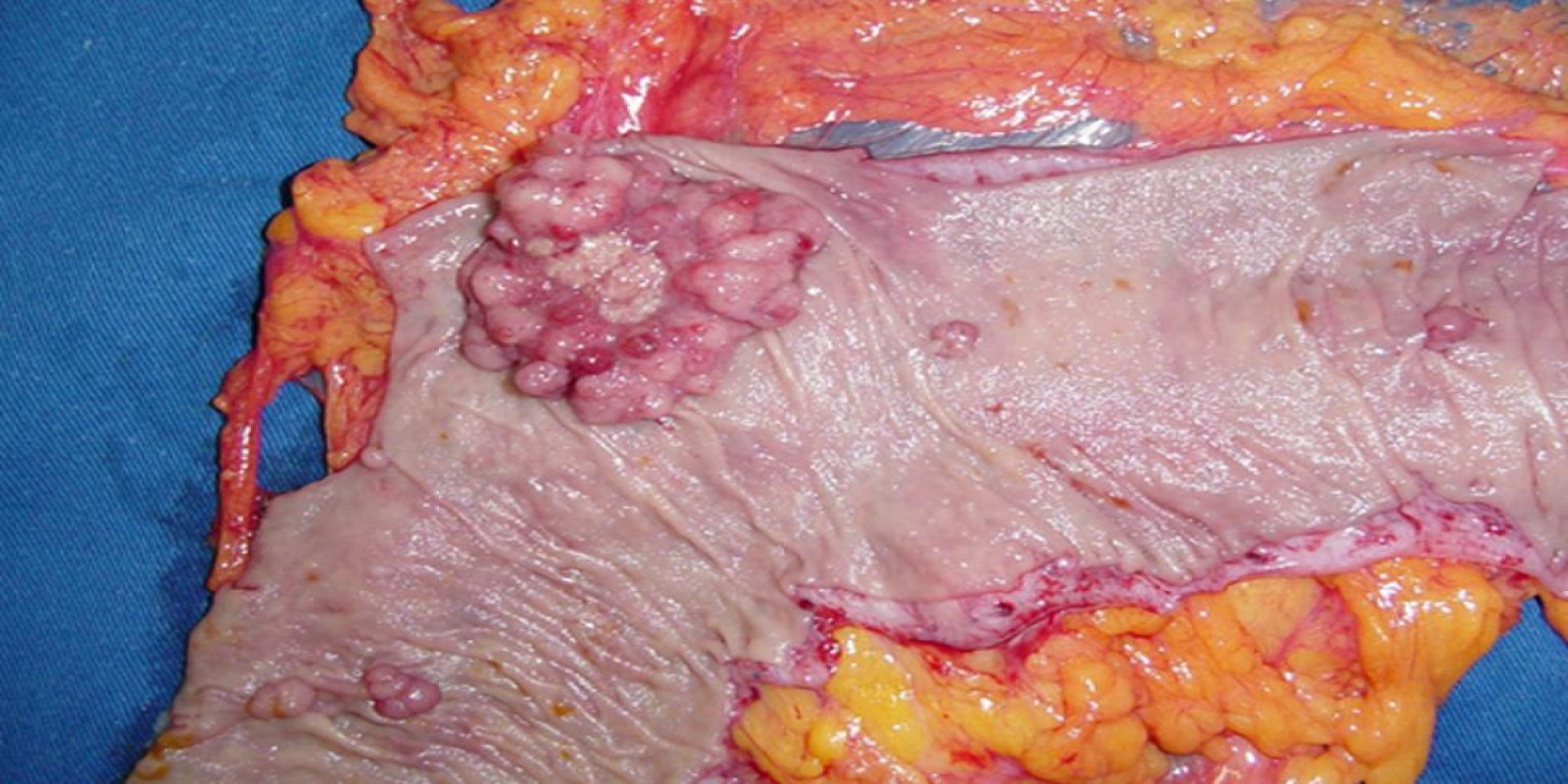 Caso Código 013A de Câncer do Cólon 013A