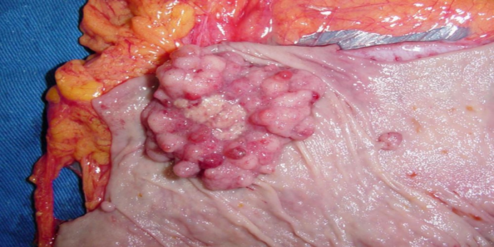 Caso Código 013B de Câncer do Cólon 013B