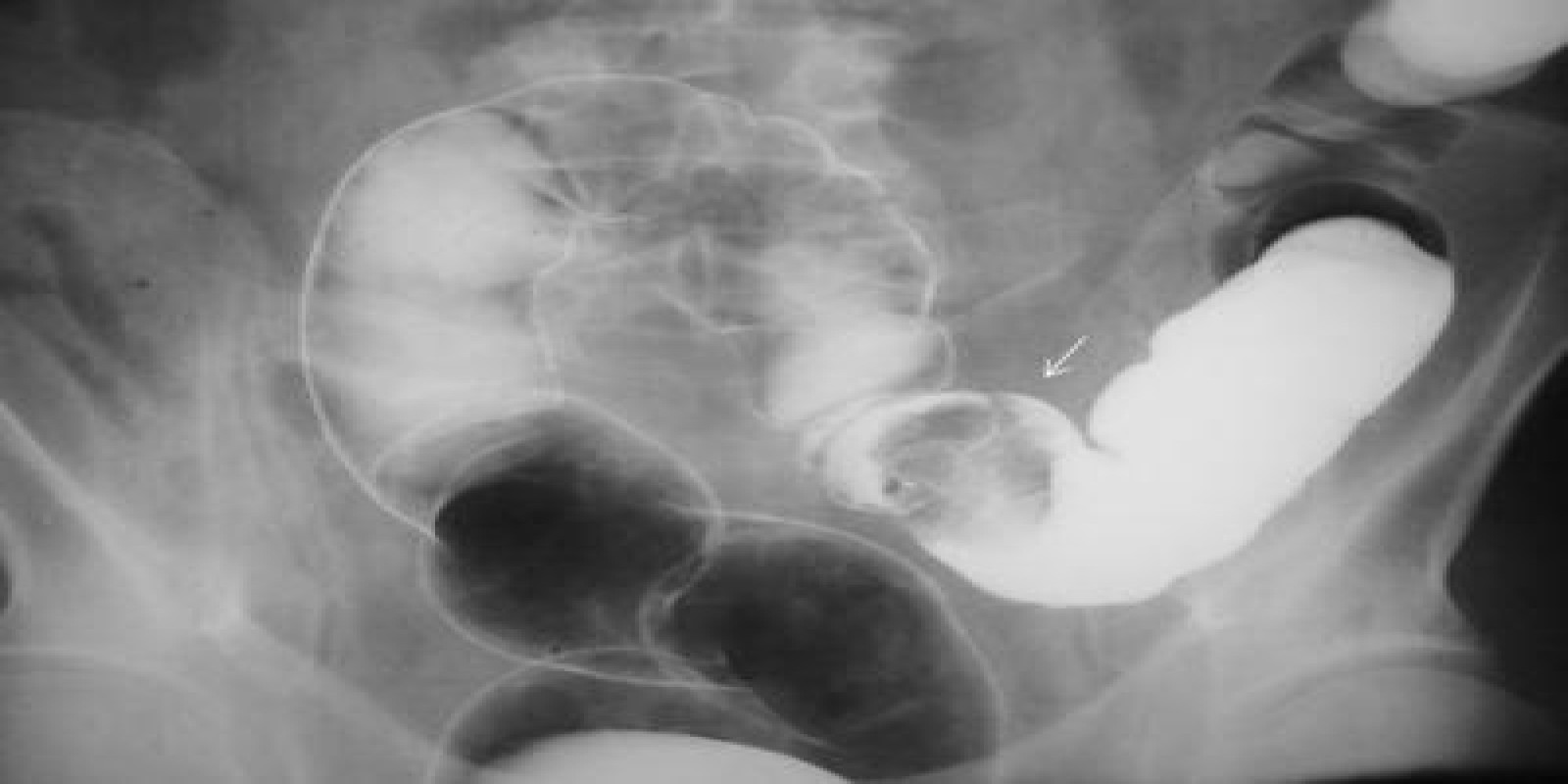 Caso Código 017A de Pólipos do Cólon 017A