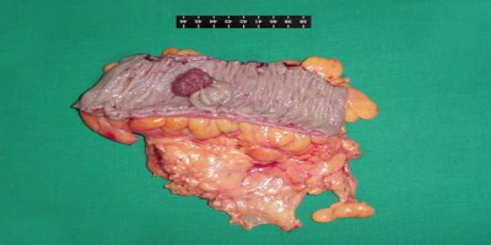 Caso Código 017B de Pólipos do Cólon 017B