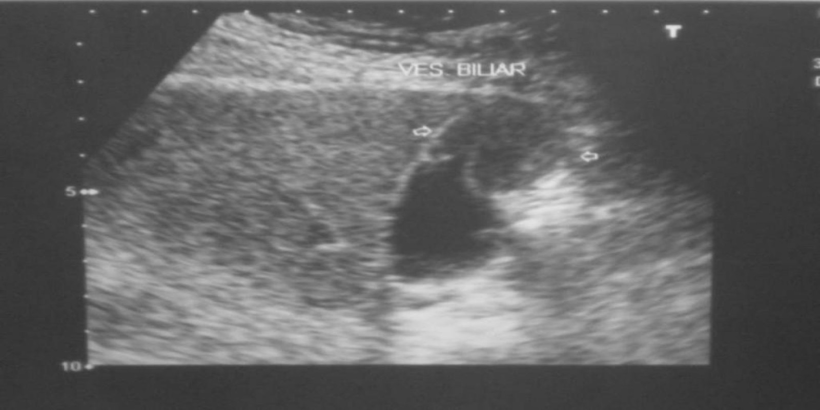 Caso Código 025A de Câncer da Vesícula Biliar 025A