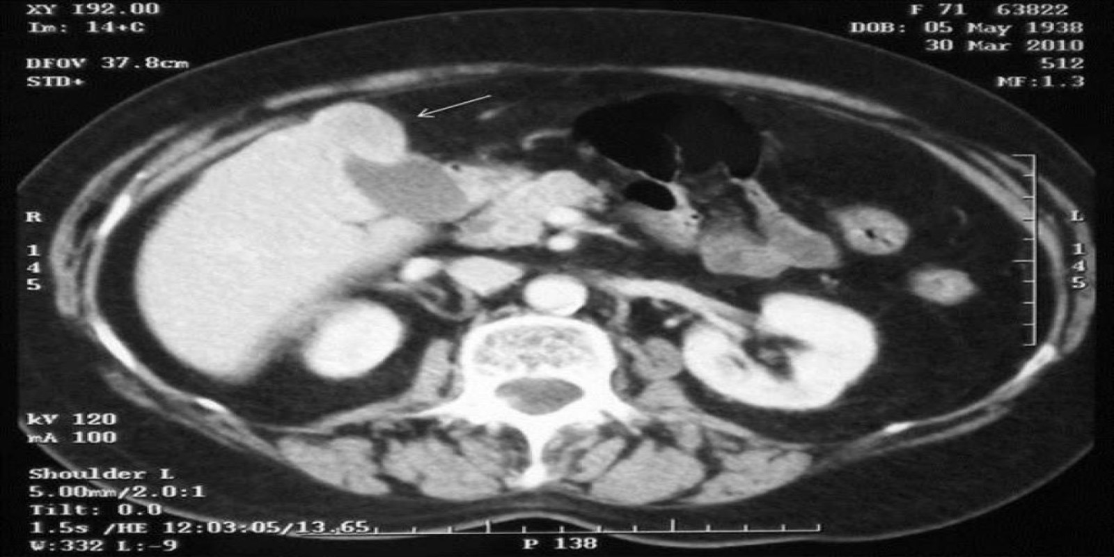 Caso Código 025B de Câncer da Vesícula Biliar 025B