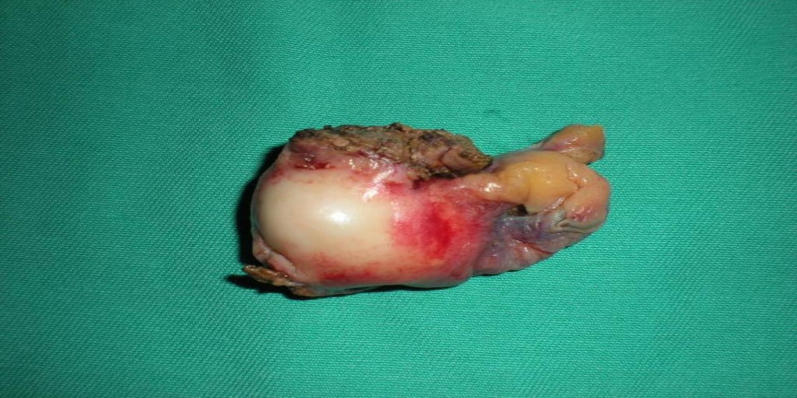 Caso Código 025C de Câncer da Vesícula Biliar 025C