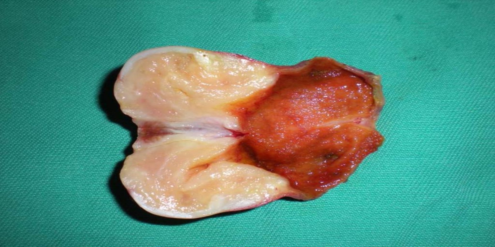 Caso Código 025D de Câncer da Vesícula Biliar 025D