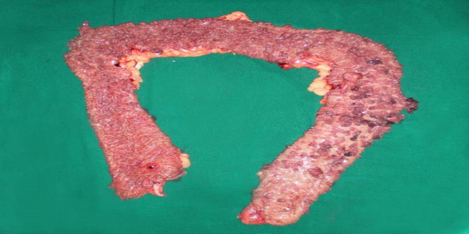 Caso Código 029A de Polipose Adenomatosa Familiar 029A