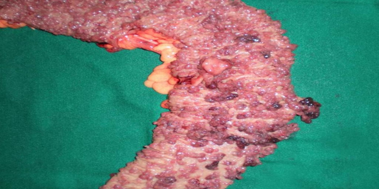 Caso Código 029B de Polipose Adenomatosa Familiar 029B