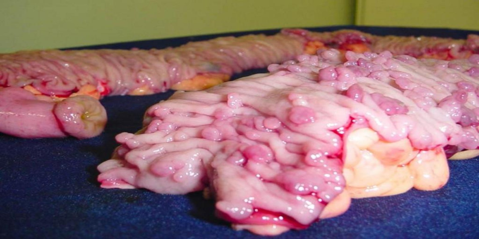 Caso Código 030C de Polipose Adenomatosa Familiar 030C