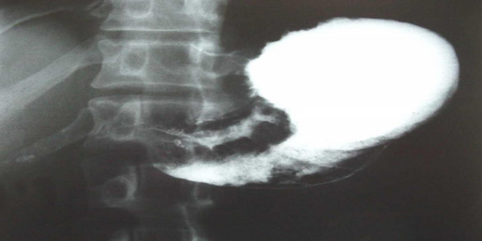 Caso Código 040A de Câncer Gástrico 040A