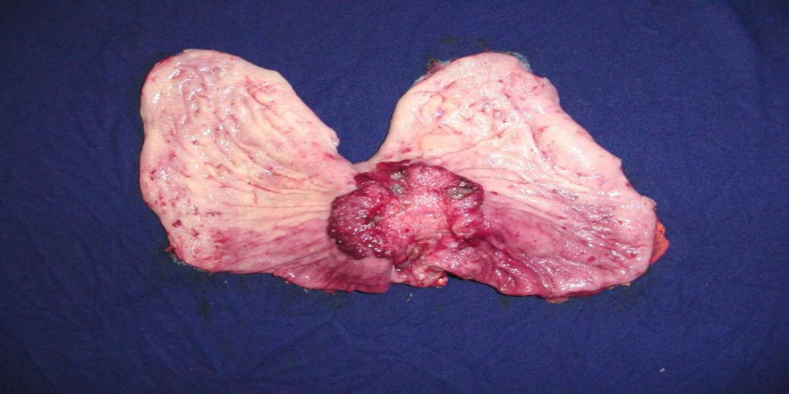 Caso Código 040C de Câncer Gástrico 040C