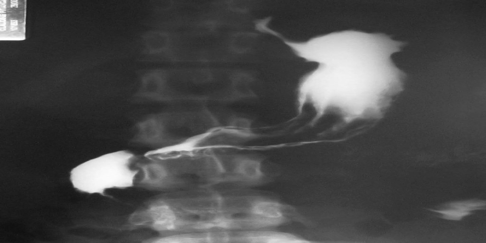 Caso Código 041B de Câncer Gástrico 041B