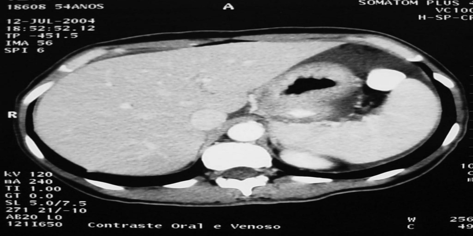 Caso Código 041C de Câncer Gástrico 041C