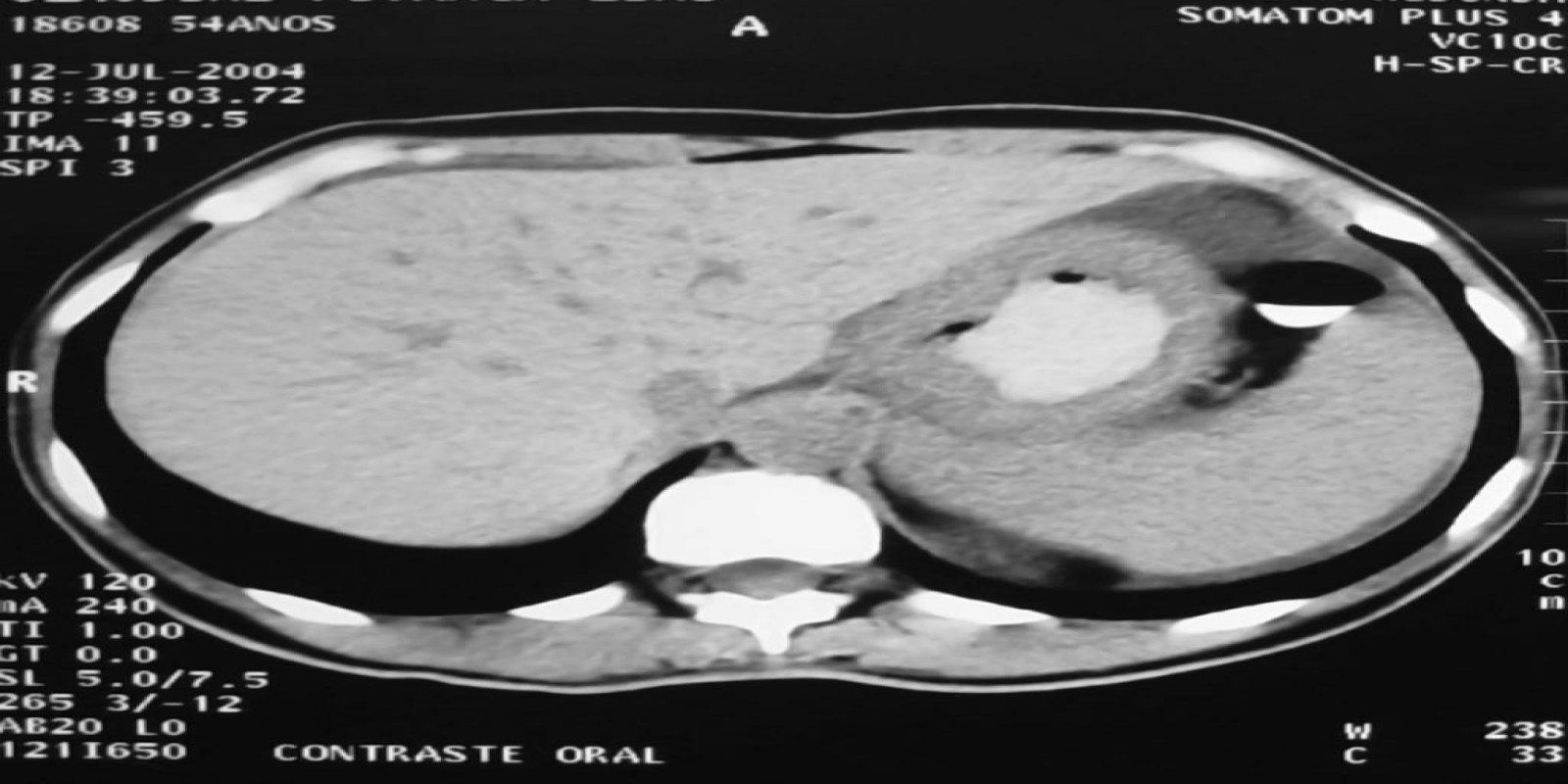 Caso Código 041D de Câncer Gástrico 041D