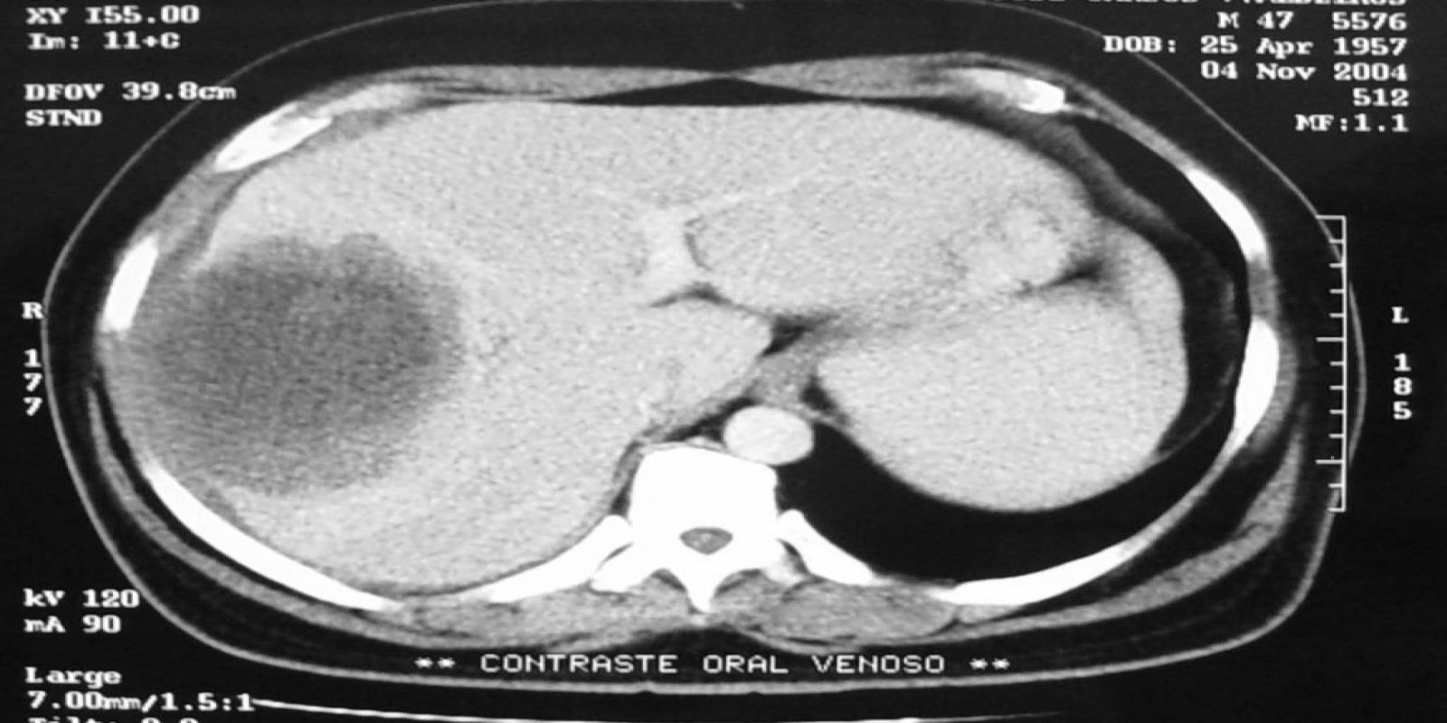 Caso Código 042A de Abscesso Hepático 042A