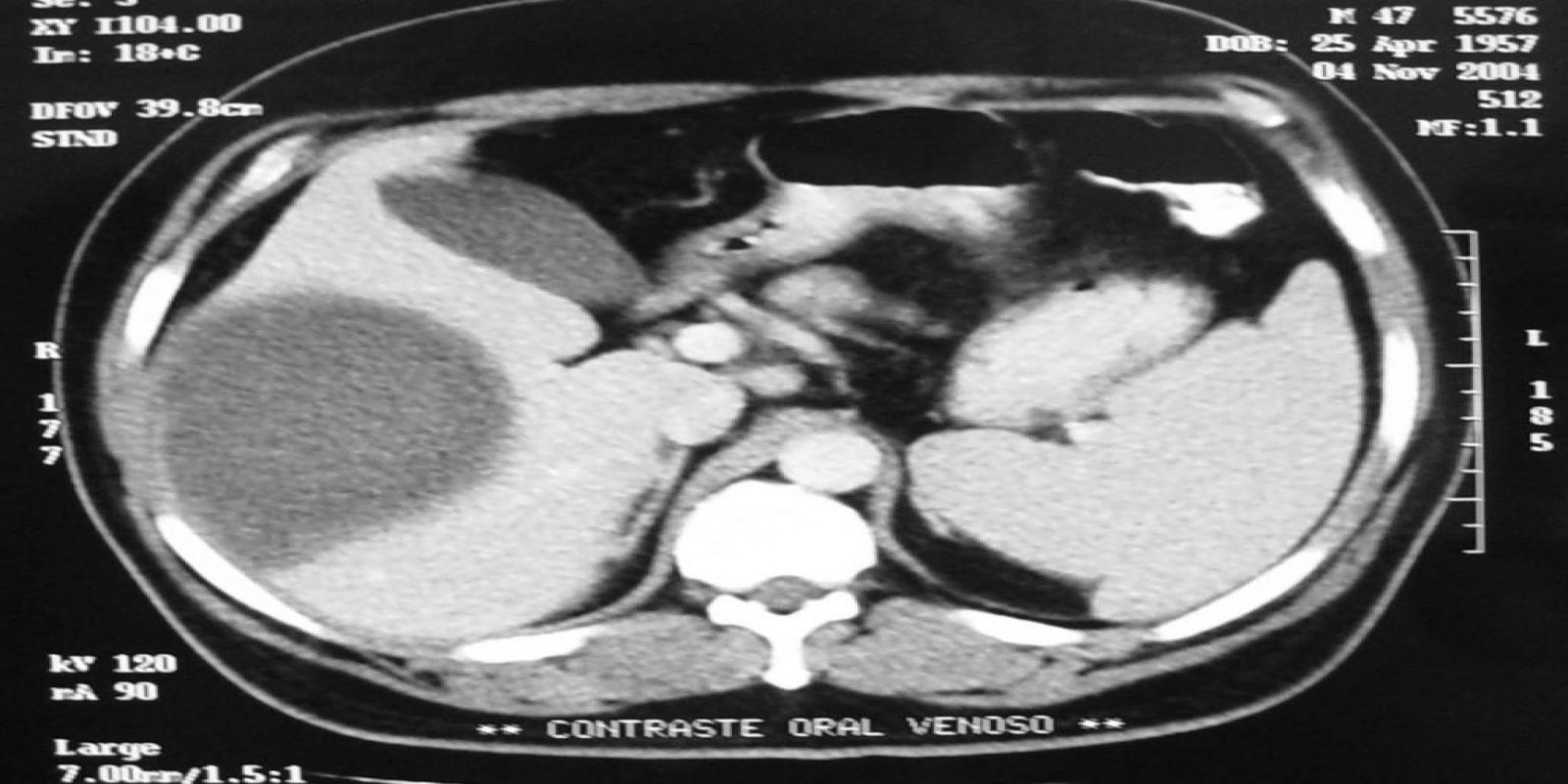 Caso Código 042B de Abscesso Hepático 042B