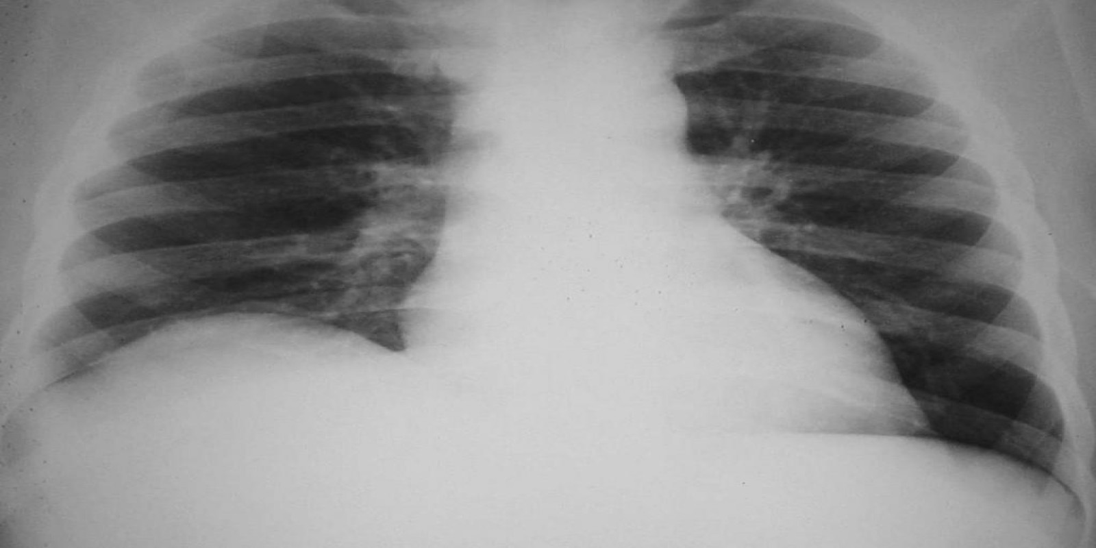 Caso Código 042C de Abscesso Hepático 042C