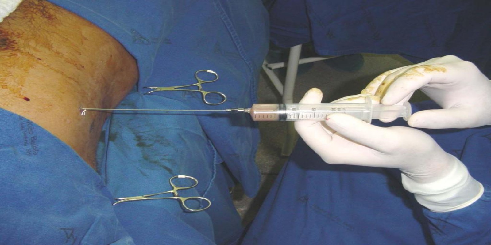 Caso Código 042D de Abscesso Hepático 042D