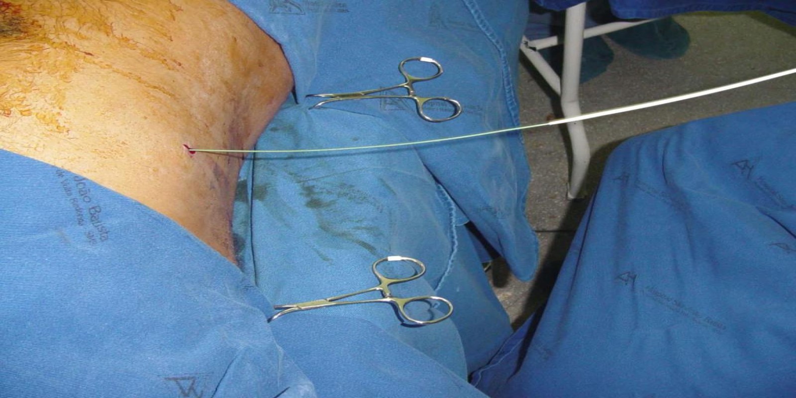 Caso Código 042E de Abscesso Hepático 042E