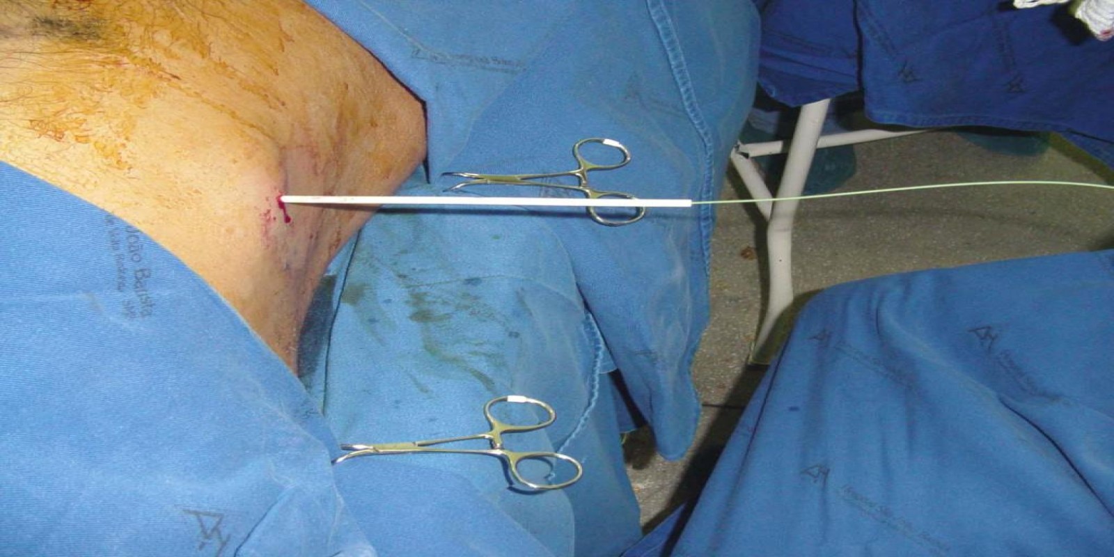 Caso Código 042F de Abscesso Hepático 042F