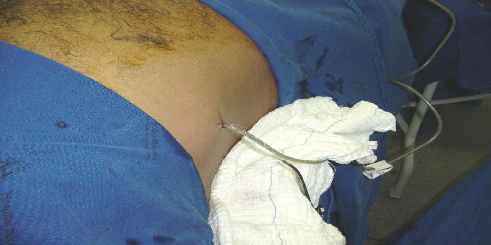 Caso Código 042G de Abscesso Hepático 042G