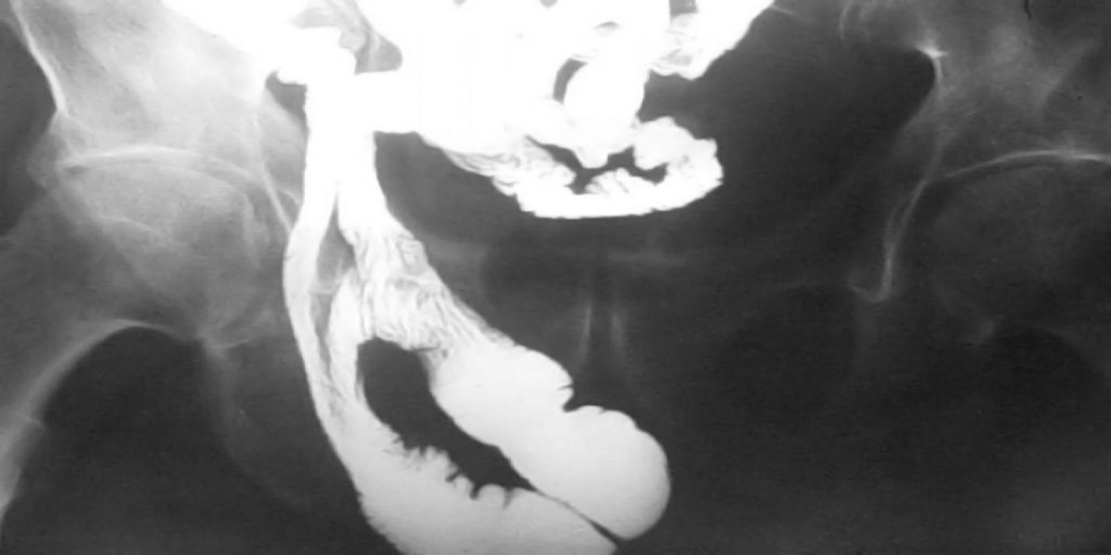 Caso Código 048A de Hérnia Inguinal 048A