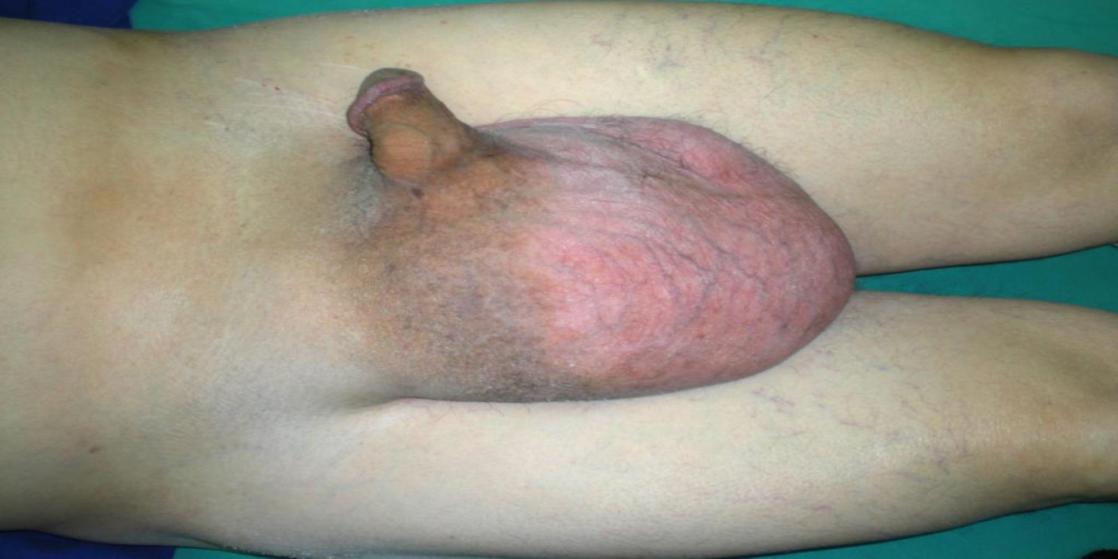 Caso Código 048B de Hérnia Inguinal 048B