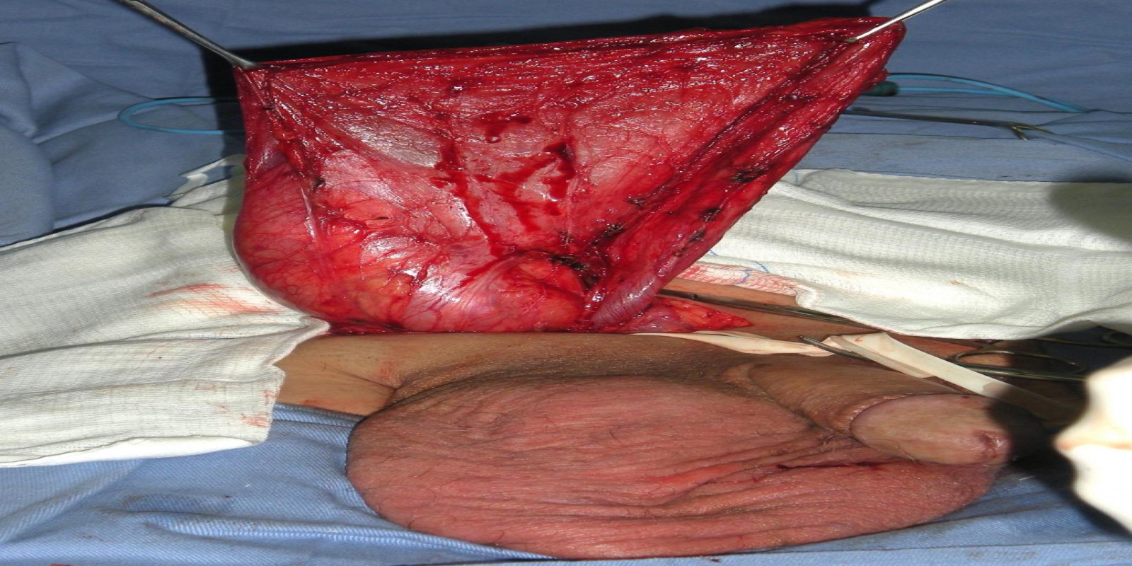 Caso Código 048C de Hérnia Inguinal 048C