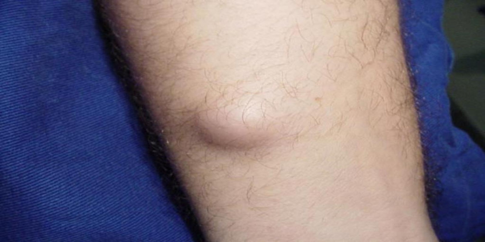 Caso Código 050A de Cisto Epidérmico 050A