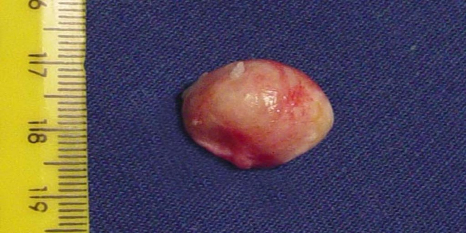 Caso Código 050B de Cisto Epidérmico 050B