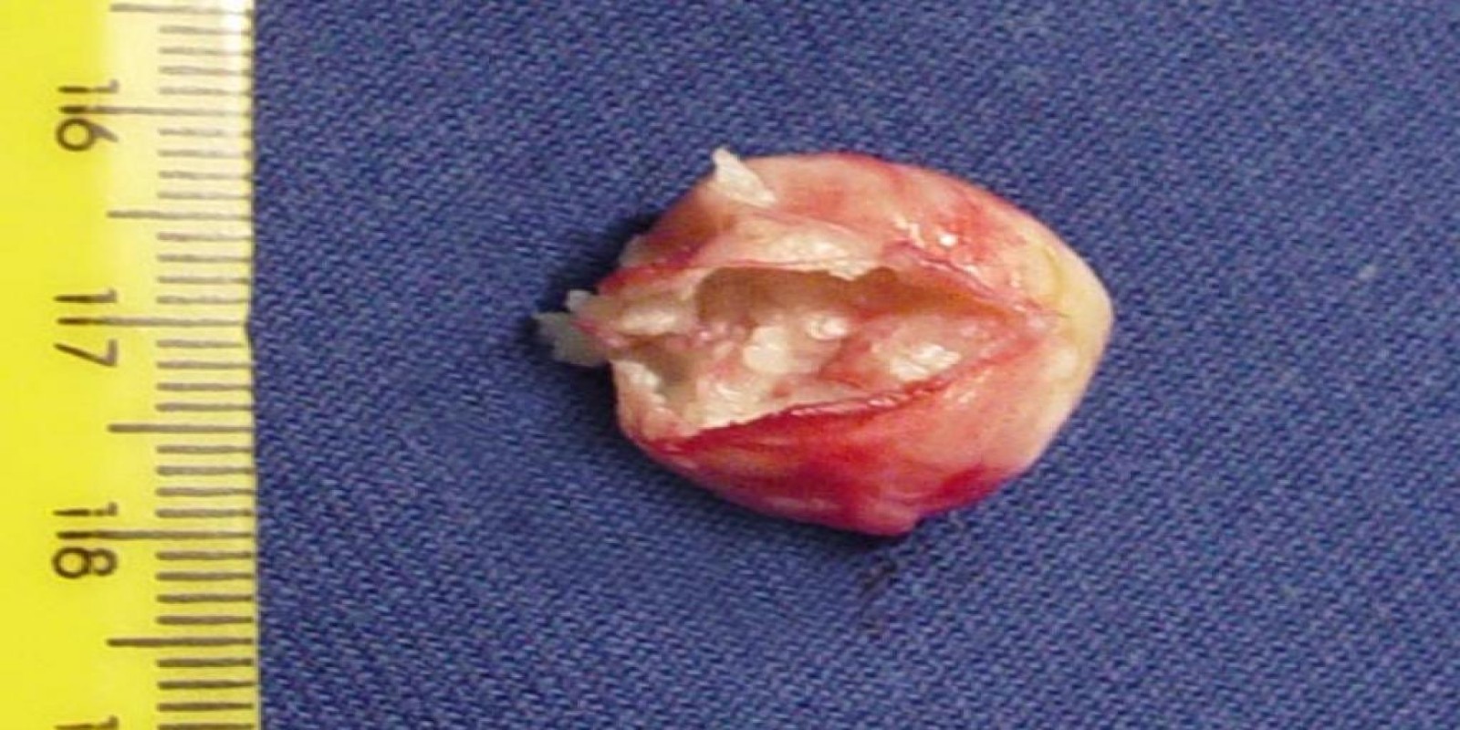 Caso Código 050C de Cisto Epidérmico 050C