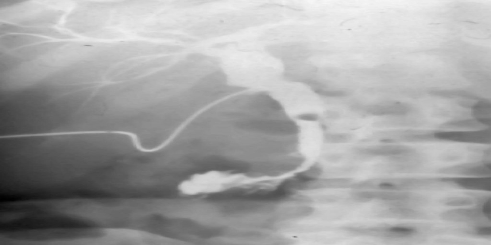 Caso Código 051A de Coledocolitíase 051A