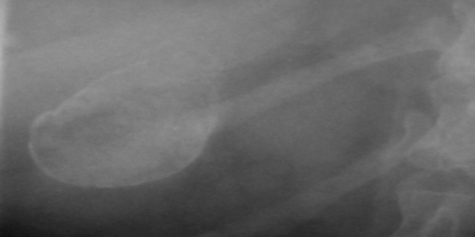 Caso Código 053A de Câncer da Vesícula Biliar 053A