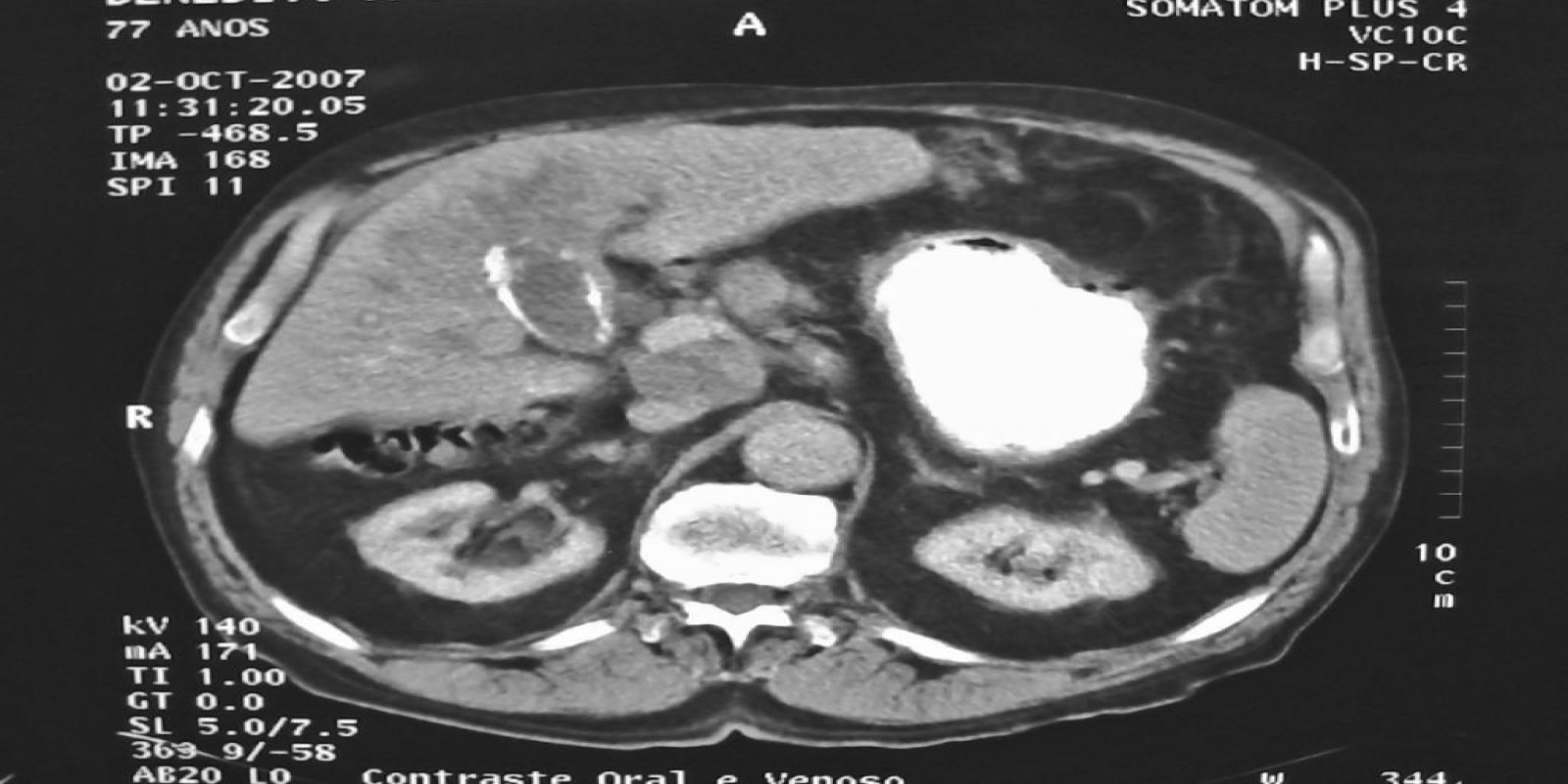 Caso Código 053B de Câncer da Vesícula Biliar 053B