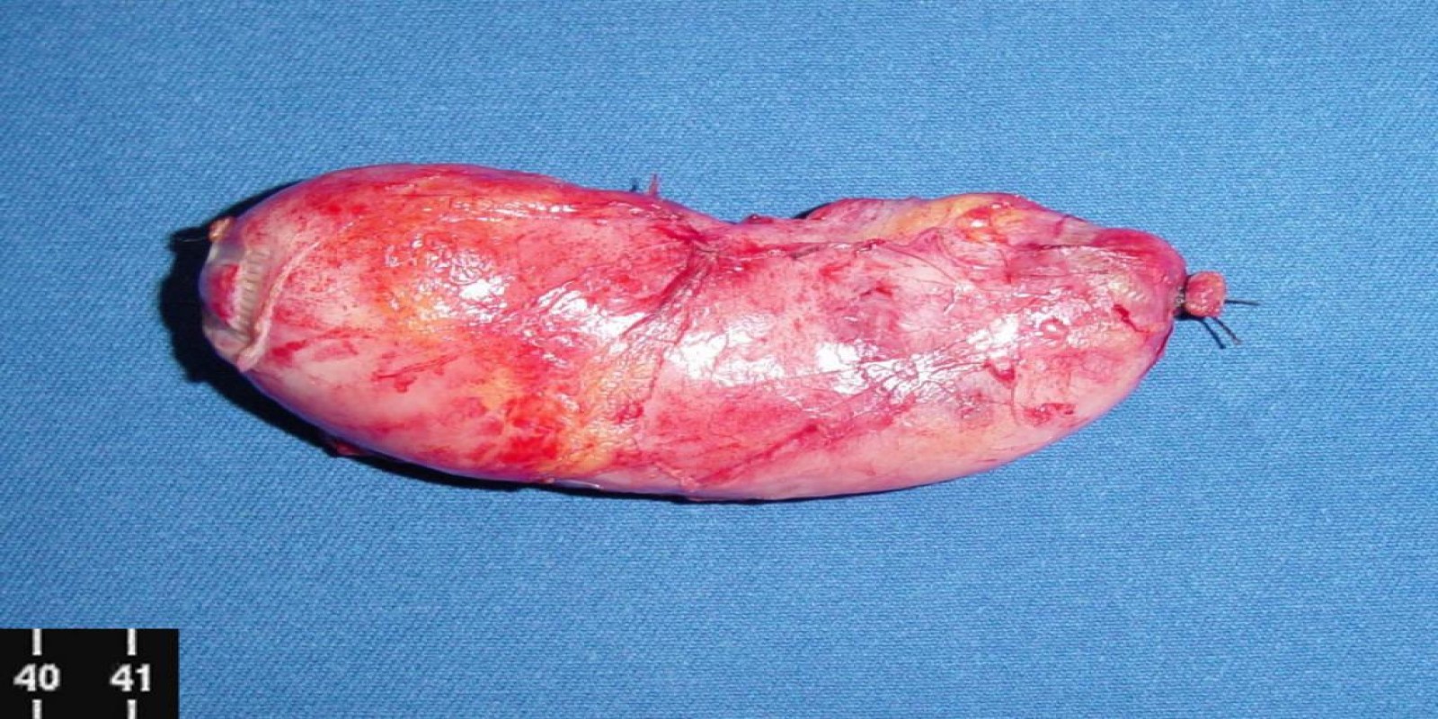 Caso Código 054A de Colecistite Aguda 054A