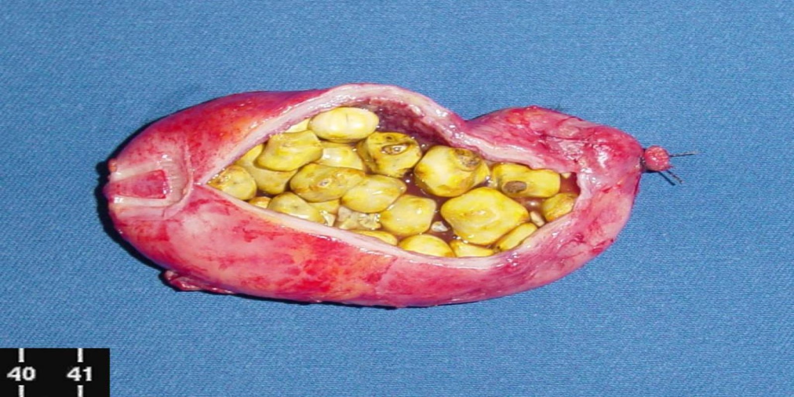 Caso Código 054B de Colecistite Aguda 054B