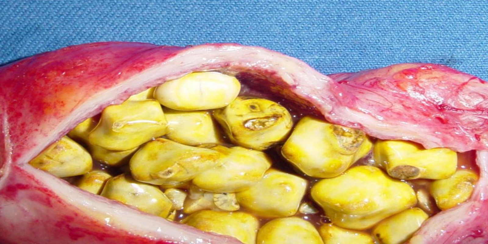 Caso Código 054C de Colecistite Aguda 054C