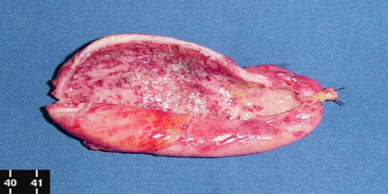 Caso Código 054D de Colecistite Aguda 054D