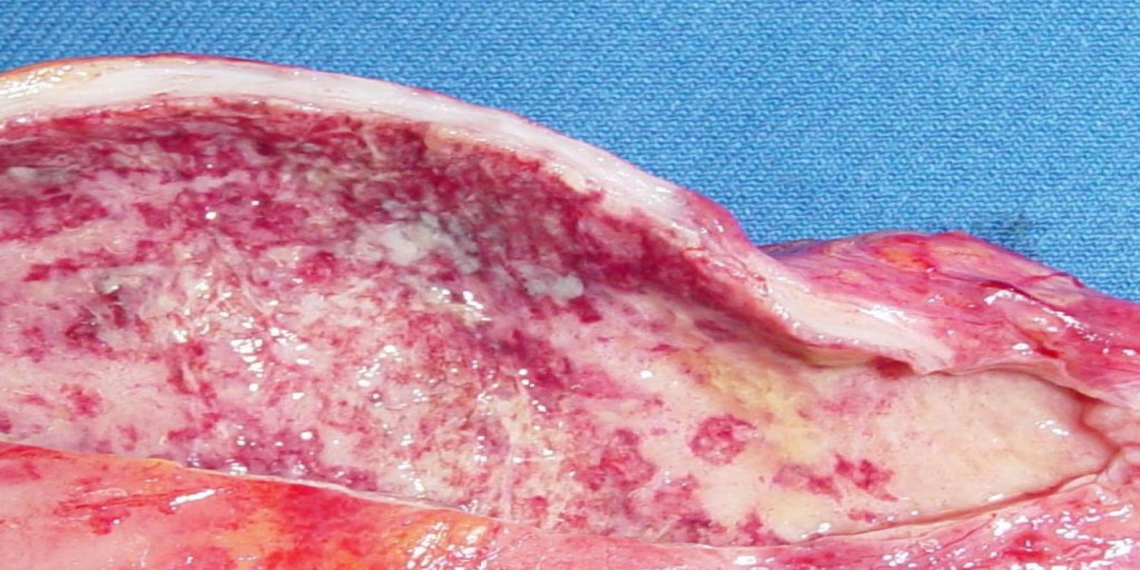 Caso Código 054E de Colecistite Aguda 054E