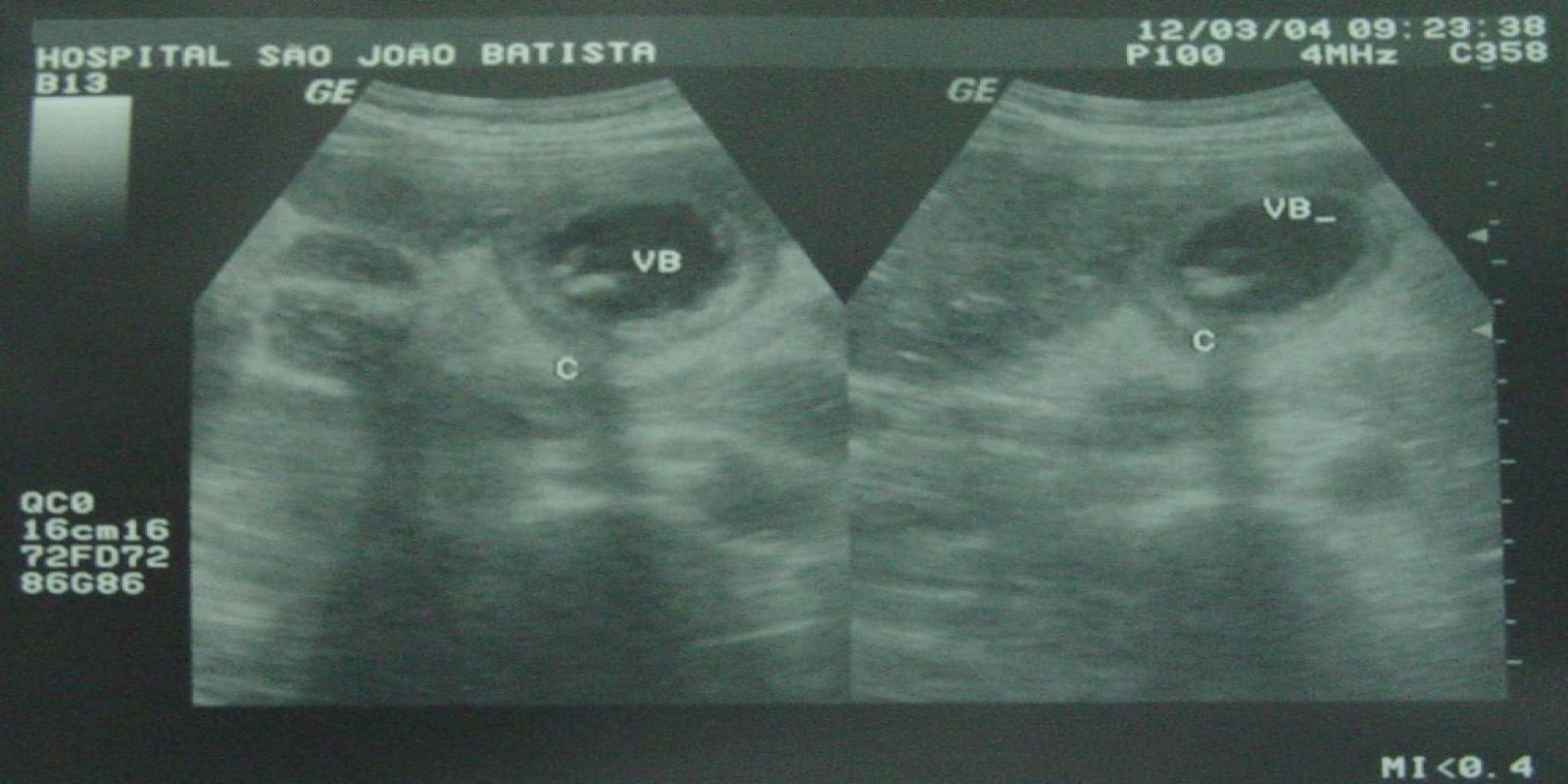 Caso Código 054F de Colecistite Aguda 054F