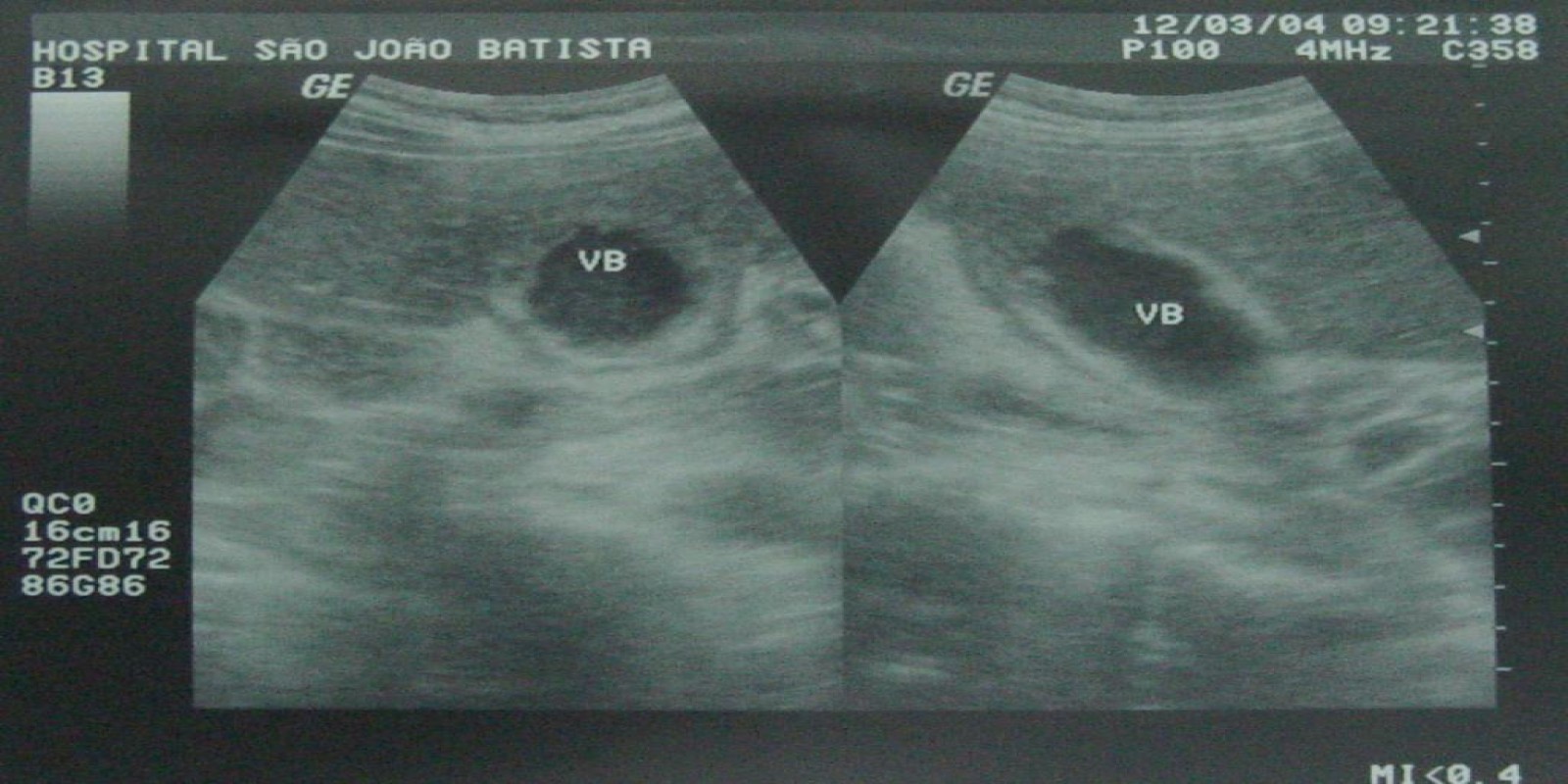 Caso Código 054G de Colecistite Aguda 054G